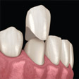 COSMETIC VENEERS